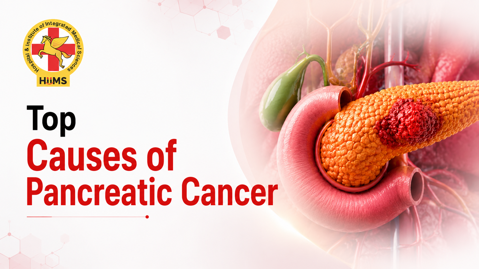 Top Causes of Pancreatic Cancer and How They Affect Health